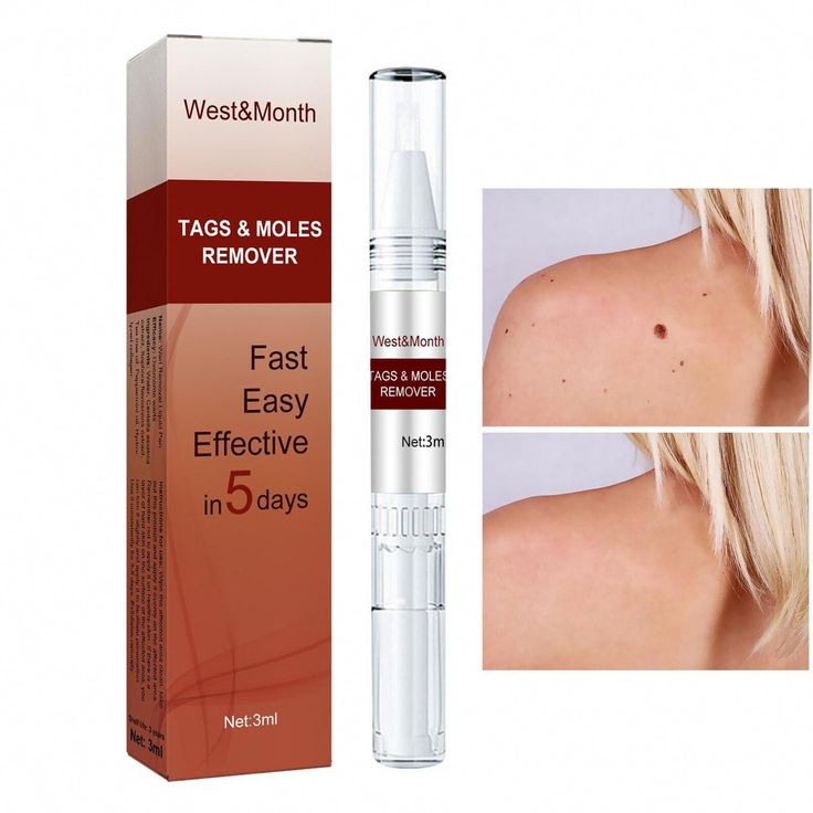 Tags & Moles Remover